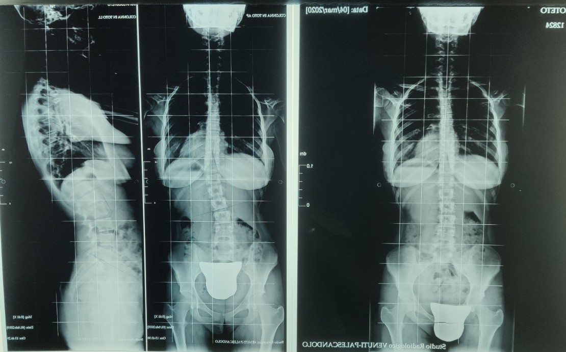 brutta radiografia della scoliosi